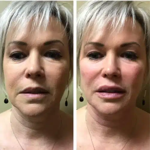 Restylane Lyft Silk 1 500x500 c