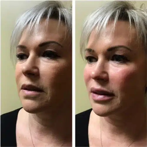 Restylane Lyft Silk 2 500x500 c