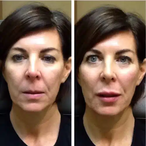Restylane Lyft Silk 500x500 c
