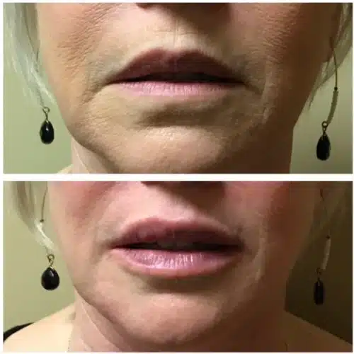 Restylane Lyft Silk Lips 1 500x500 c
