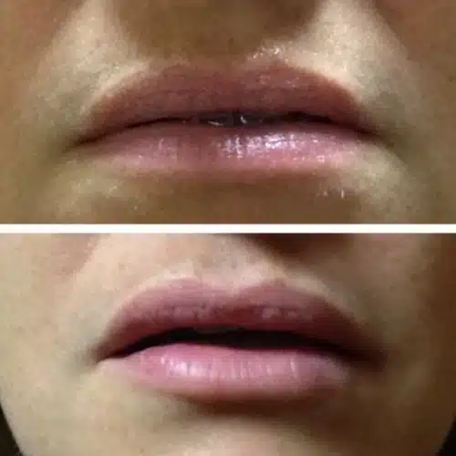 Restylane Lyft Silk Lips 500x500 c