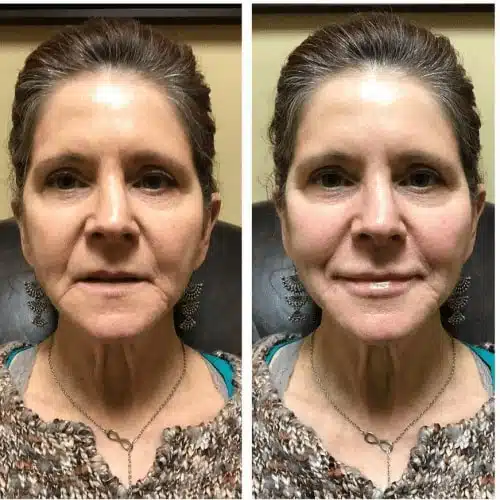 restylane lyft silk 3 500x500 c