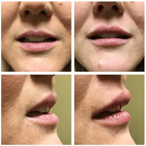 restylane silk lips 500x500 c