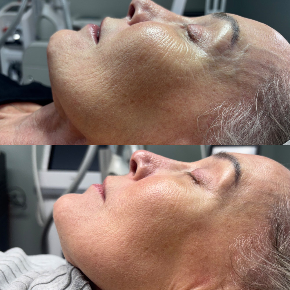 coolpeel-before-after-1