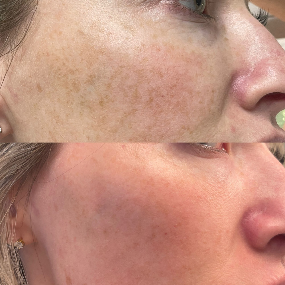 coolpeel-before-after-2