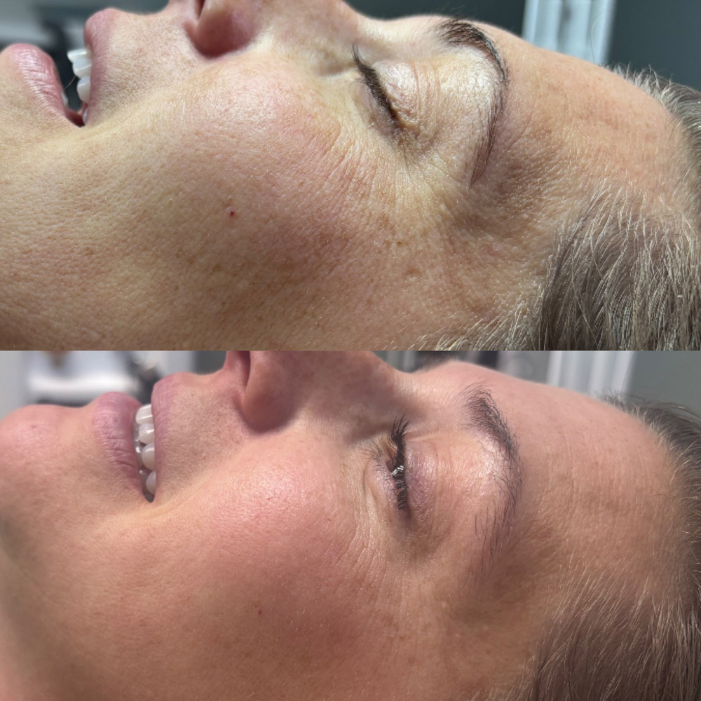 coolpeel-before-after-3
