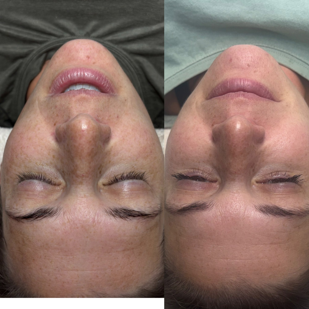 coolpeel-before-after-4