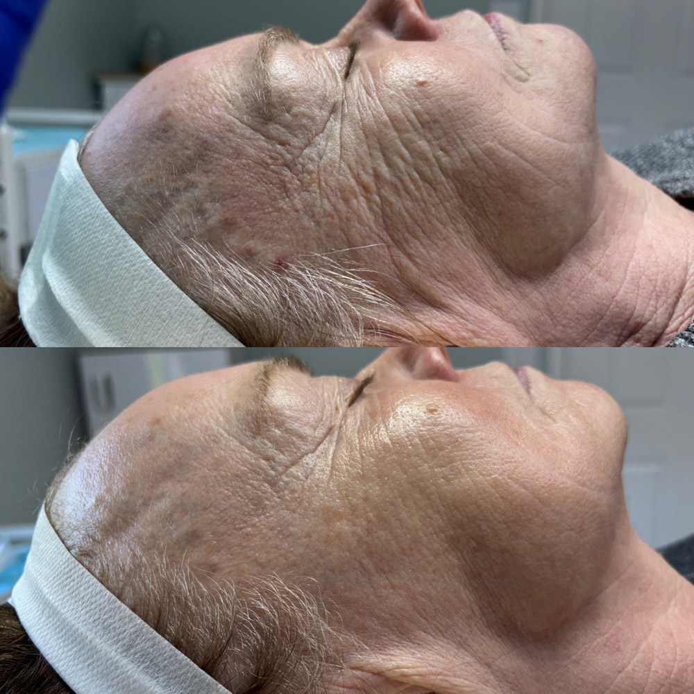 rf-microneedling-before-after-1