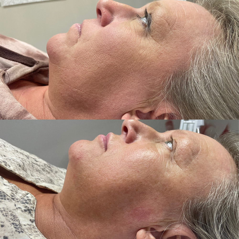 rf-microneedling-before-after-2