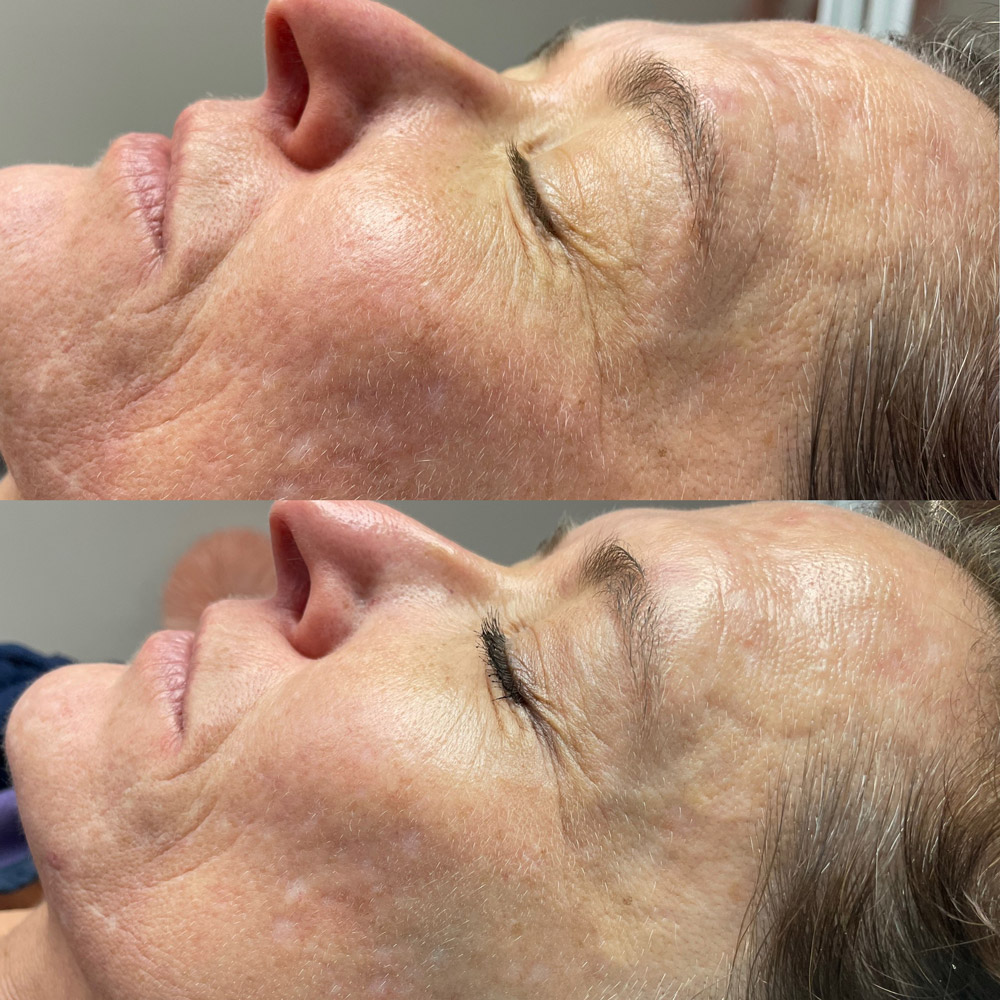 rf-microneedling-before-after-3