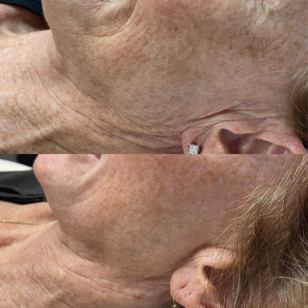 rf-microneedling-before-after-4