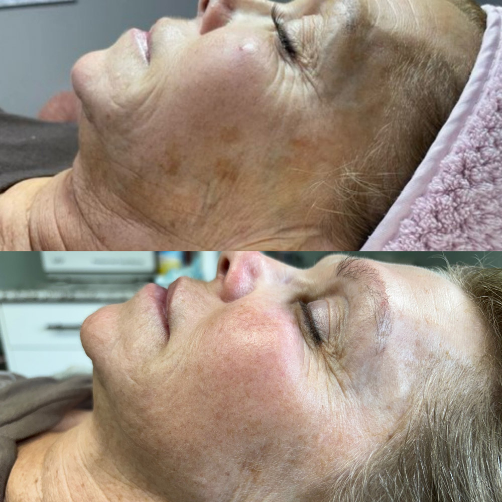 rf-microneedling-before-after-5