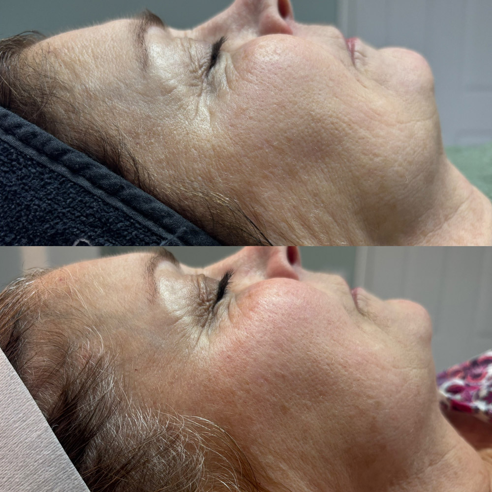 rf-microneedling-before-after-6