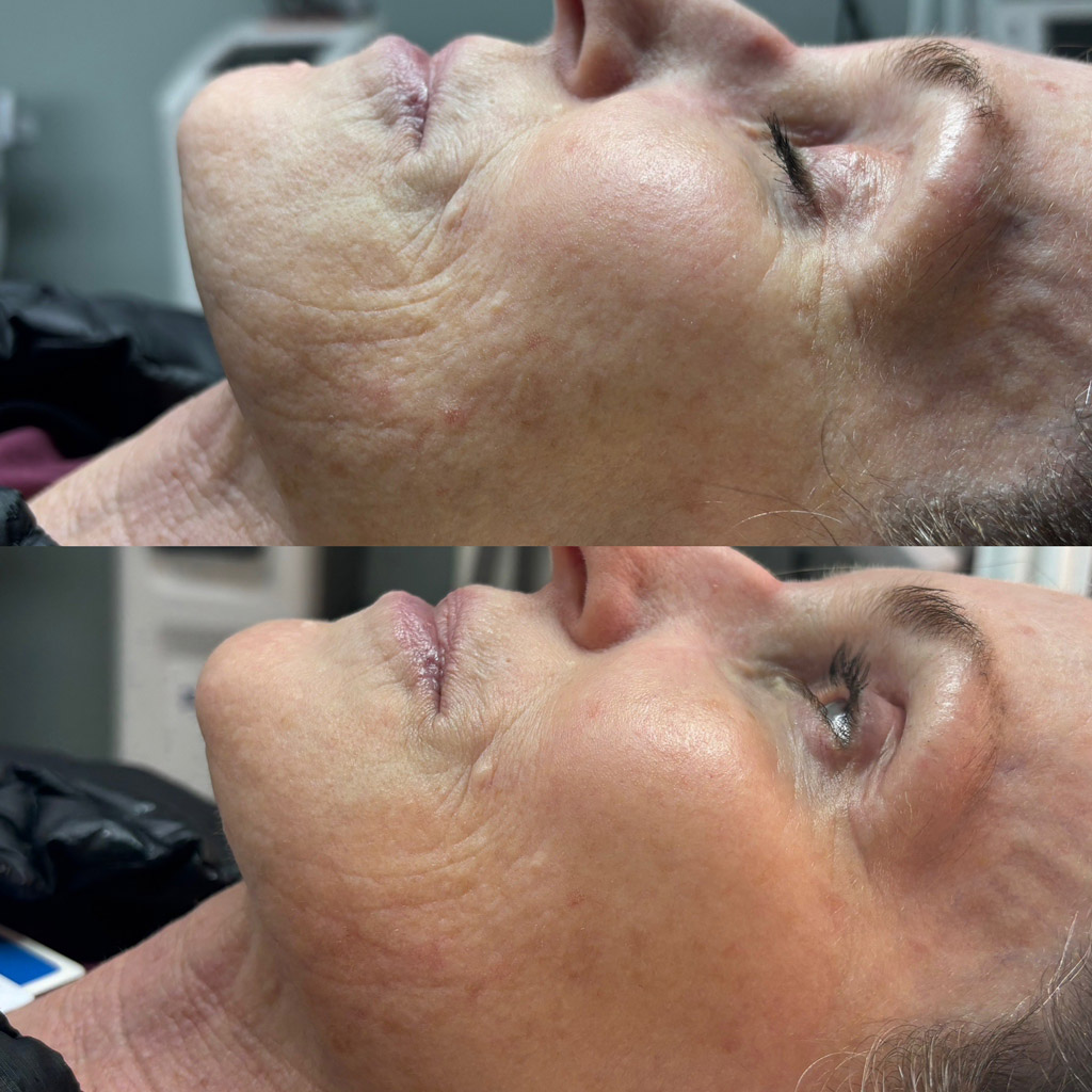 rf-microneedling-before-after-7