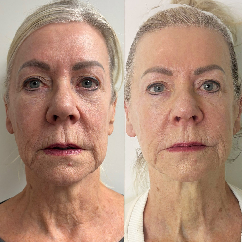 xerf-before-after-1