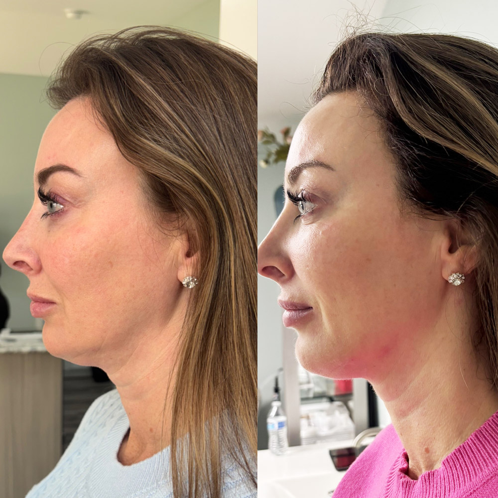 xerf-before-after-2