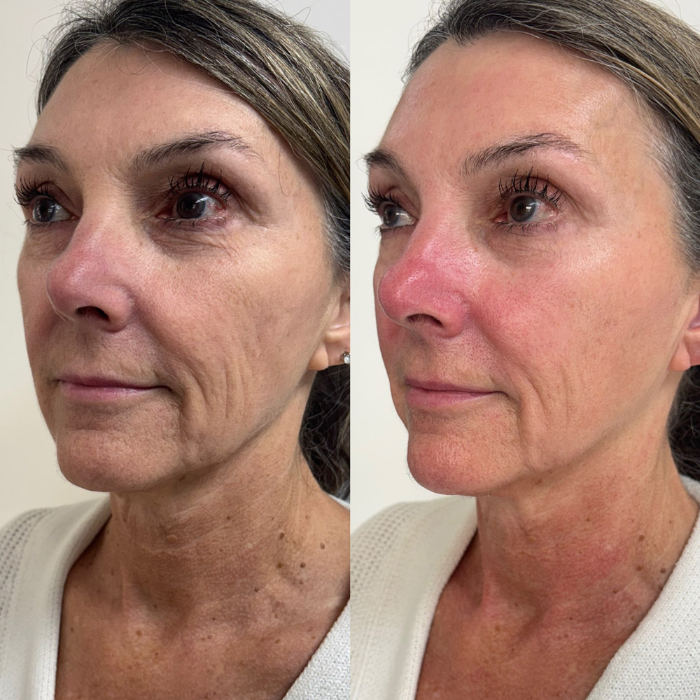 xerf-before-after-3
